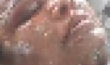 टिफिन सेंटर में प्रेशर कुकर फटने से महिला झुलसी:पुराने कुकर और गैस के इस्तेमाल से हुआ हादसा; चेहरा, हाथ और पेट जला